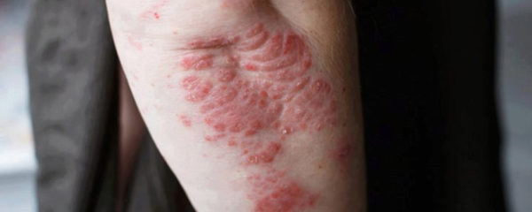 psoriasis