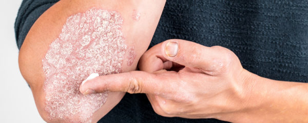 eczéma
